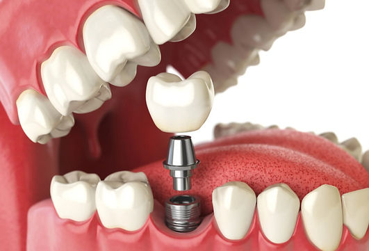 Dental İmplant and Crowns