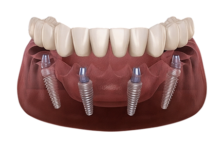 ALL ON FOUR IMPLANT