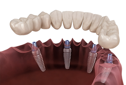 All-on-Four-Implantate