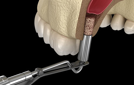 SINUS LIFTING