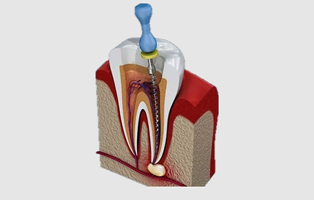 ROOT CANAL TREATMENT