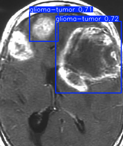 Brain Tumor Detection
