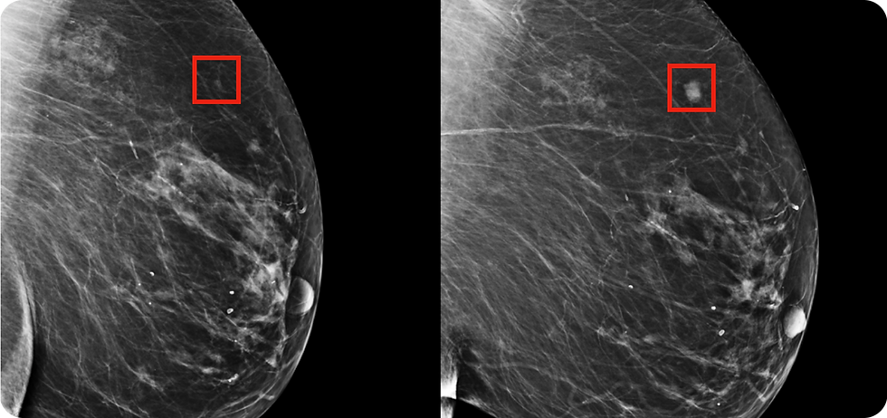 Breast Cancer Detection
