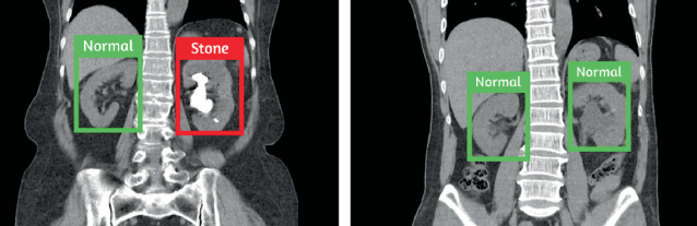 Kidney Stone Detection