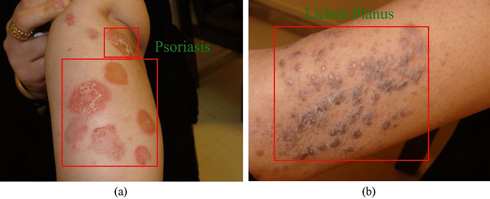 Skin Disease Detection