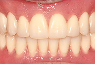 dentures.png