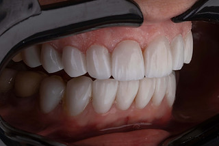 dentures.jpg
