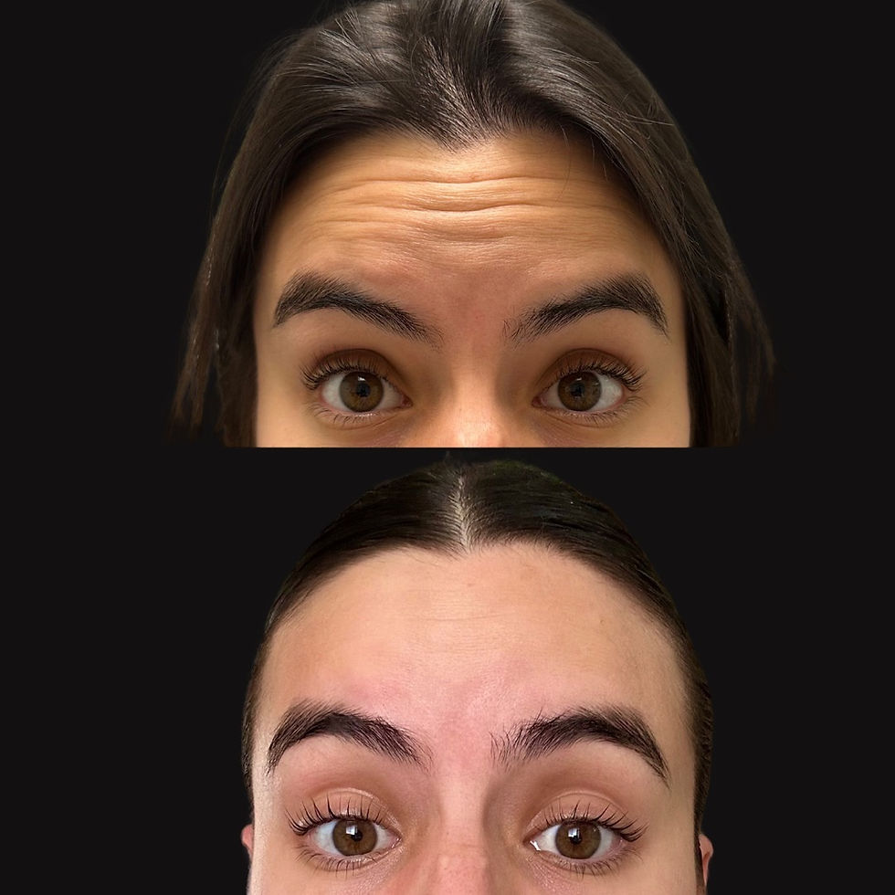 Botox Aftercare: What to Expect and What’s Normal