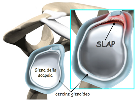 RIPARAZIONE ARTROSCOPICA DEL LABBRO POSTERIORE DI SPALLA
