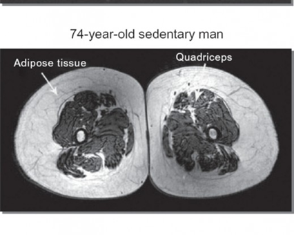 Sarcopenia