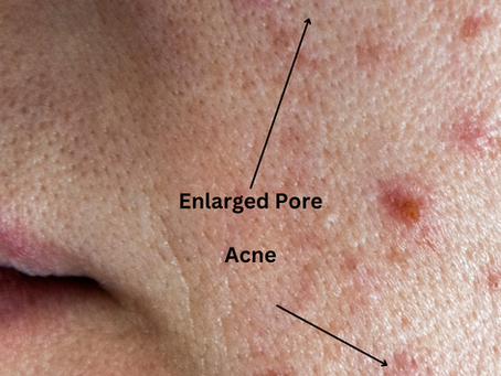 Understanding Acne and Enlarged Pores: A Guide to Clearer Skin