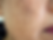 melasma.png