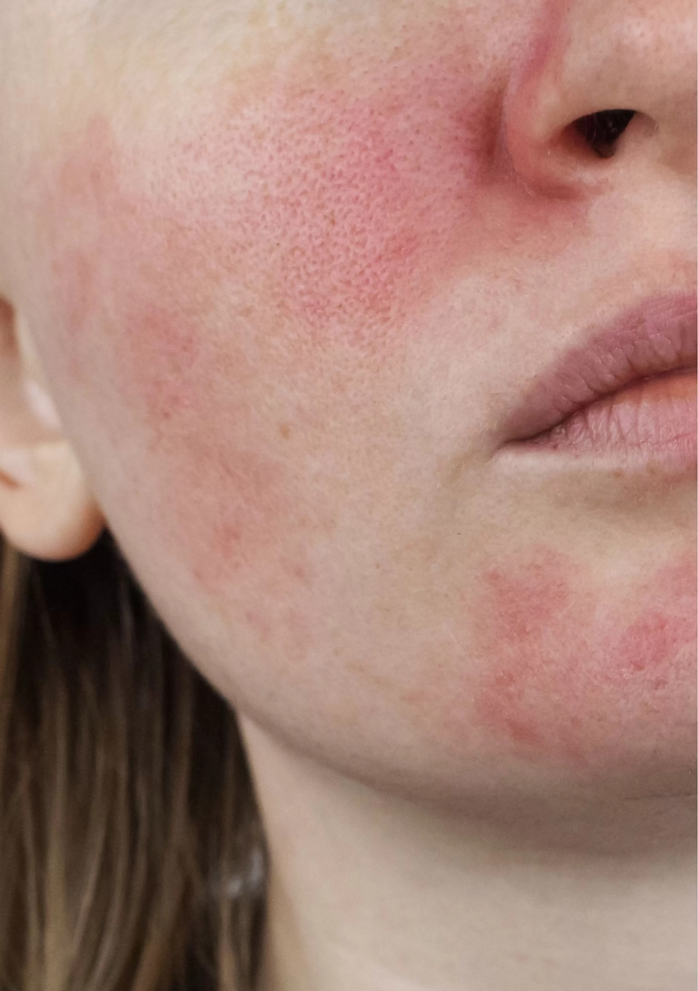 superclear laser redness.png