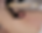 Alma Co2 scar main.png