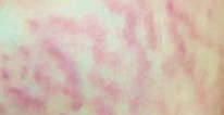 bartonella stretch mark rash 2_edited.jpg