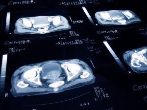 High-dose radiation touted as ‘safe and effective’ for early prostate cancer. Total study score: 2 o