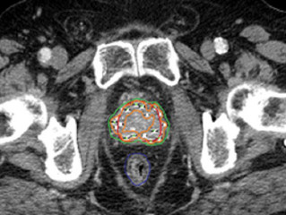 Intermediate risk prostate cancer may be well controlled with brachytherapy alone
