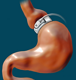 Bild von Magen mit Magenband