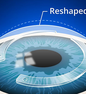 img-cornea-treatment.jpg