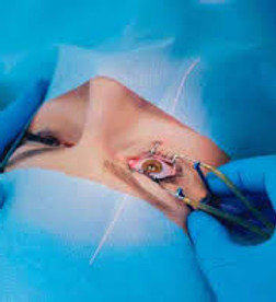 img-best-femto-lasik-surgeon.jpg