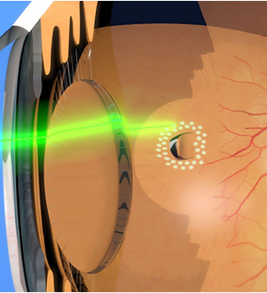 img-retinal-hole-laser-treatment.png