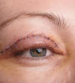 img-eyelid-surgery.jpg