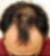 Alopecia Androgenetica - voor
