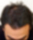 Alopecia Androgenetica - na