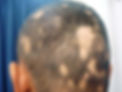 Alopecia Areata