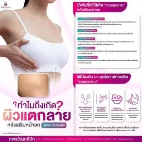 บอกลาผิวแตกลายหลังเสริมหน้าอก