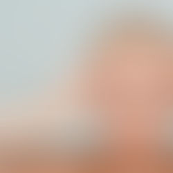 เสริมหน้าผากคืออะไร? แตกต่างจากฟิลเลอร์หน้าผากอย่างไร