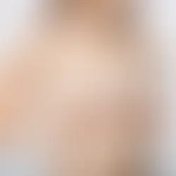 วิธีดูแลตัวเองหลังทำนม ห้ามทำอะไรบ้าง? ใช้เวลากี่เดือนถึงเข้าที่