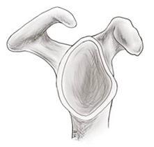 Acromion-Typ-III.png