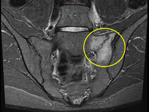 Sacral Stress Fracture