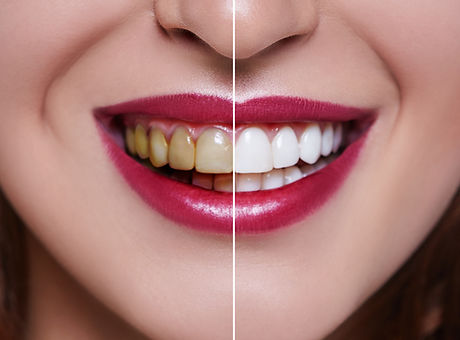Whitening.jpg