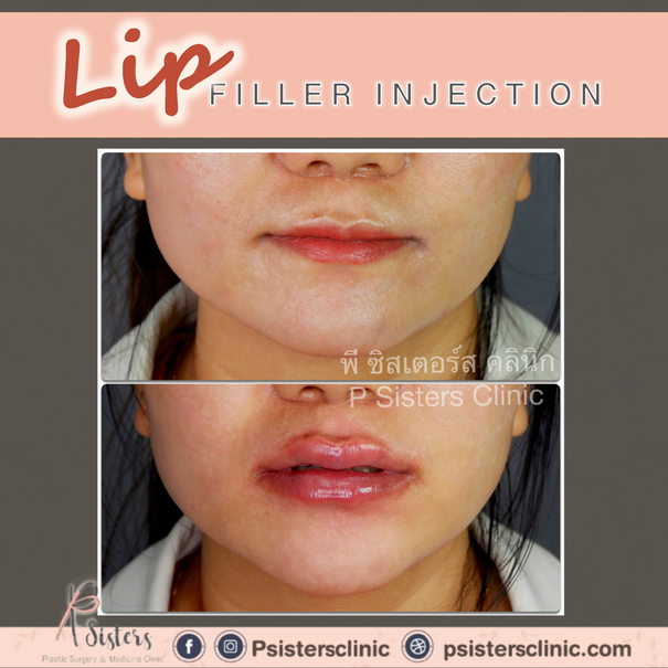 lip111.png