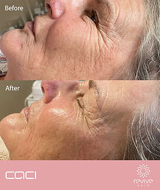 CACI Before&After at Revive Skin Peterborough