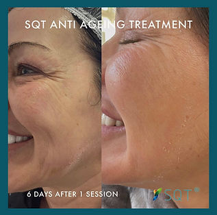 SQT before and after - available at Revive Skin Peterborough