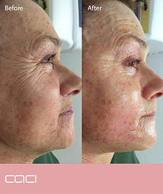 CACI Before&After at Revive Skin Peterborough