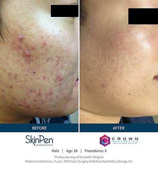 SkinPen Before&After