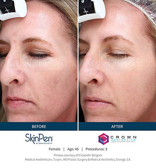 SkinPen Before&After