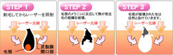 脱毛の種類について