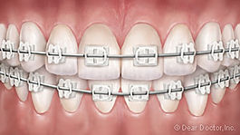 clear-braces.jpg