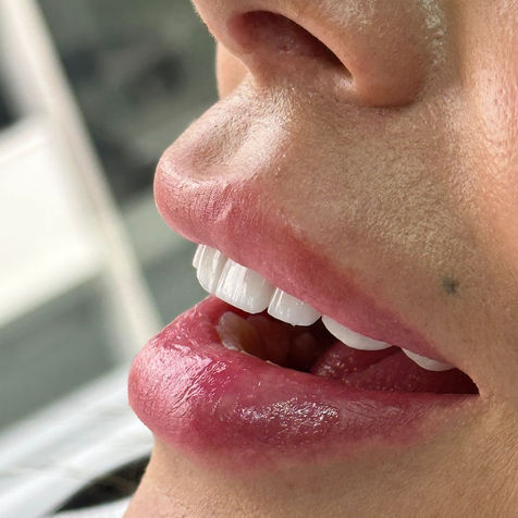 Resins Veneers - Dra. Katherine Ochoa