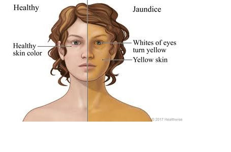 Jaundice