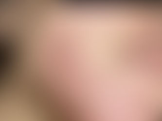 皮膚美容專科痤瘡的護理----- 認識痤瘡
