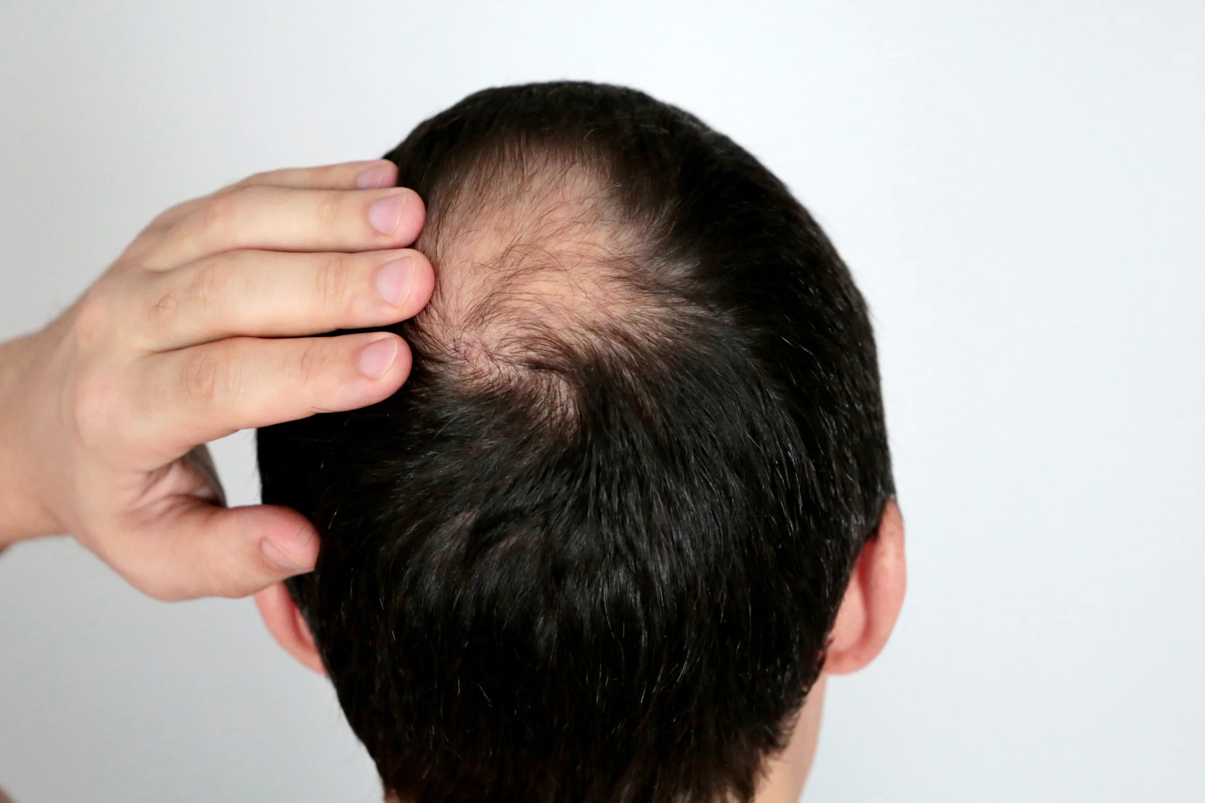 Hair balding.webp