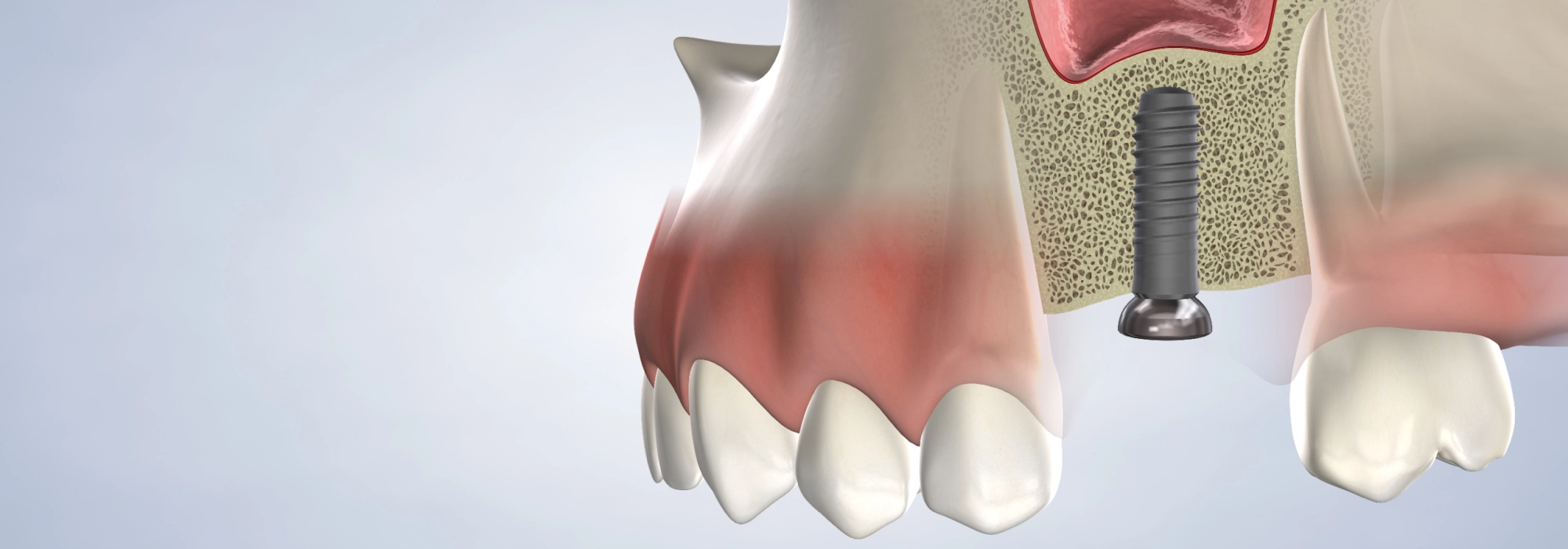 bone-grafting-landscape.webp
