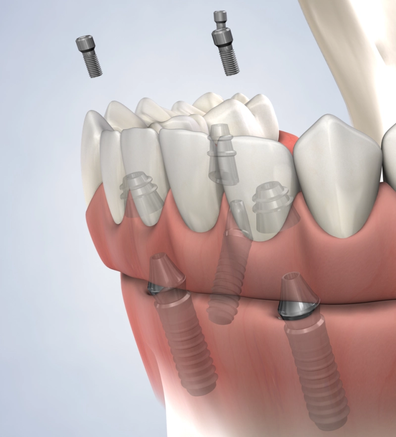 full-arch-restoration-procedure-query-page.webp