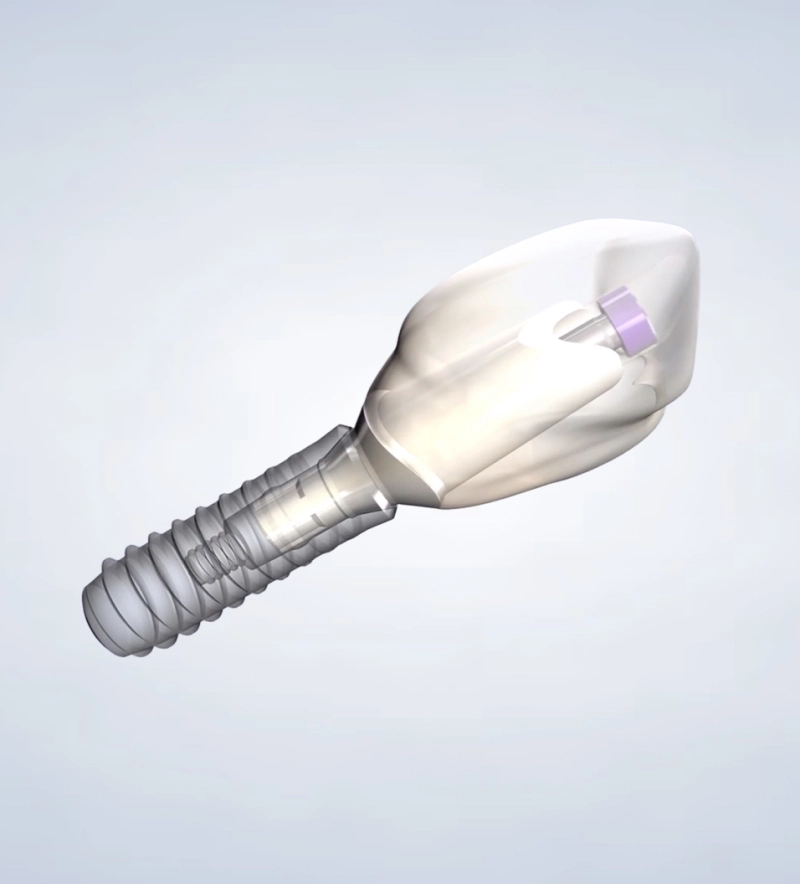 Dental Implant.webp